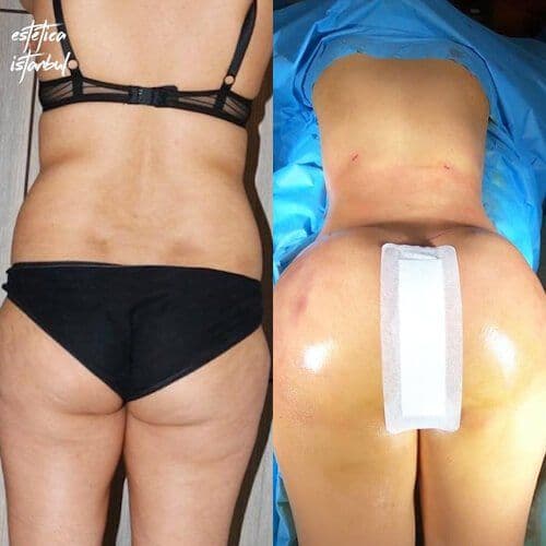 Brazilian Butt Lift Before After Turkey