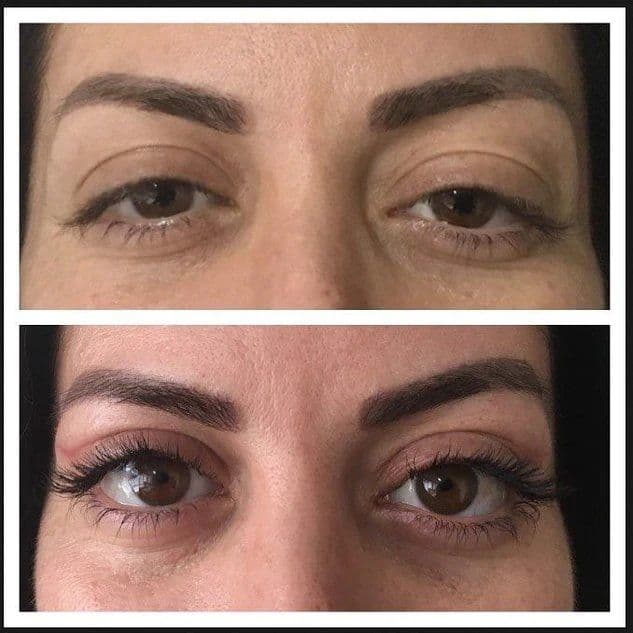 Blepharoplastie Before After 03