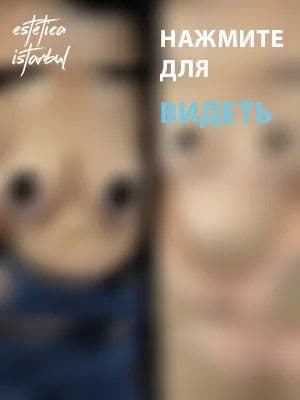 Breast Before After Ru 8 1 1