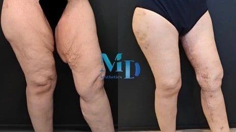 Thigh Lift Before After Photo 02