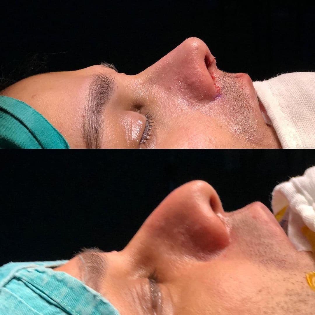 Rhinoplasty Surgery Before After Male