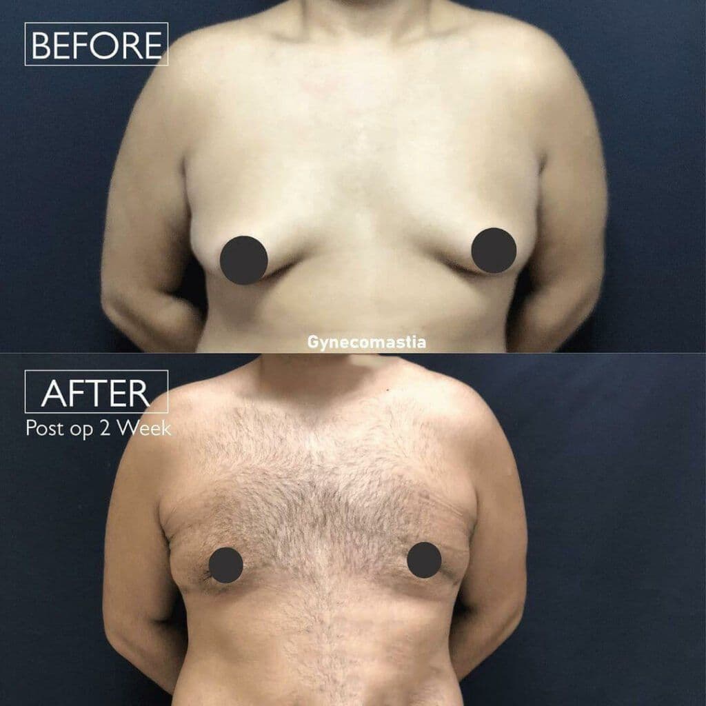 Before And After Gynecomastia Photos In Turkey