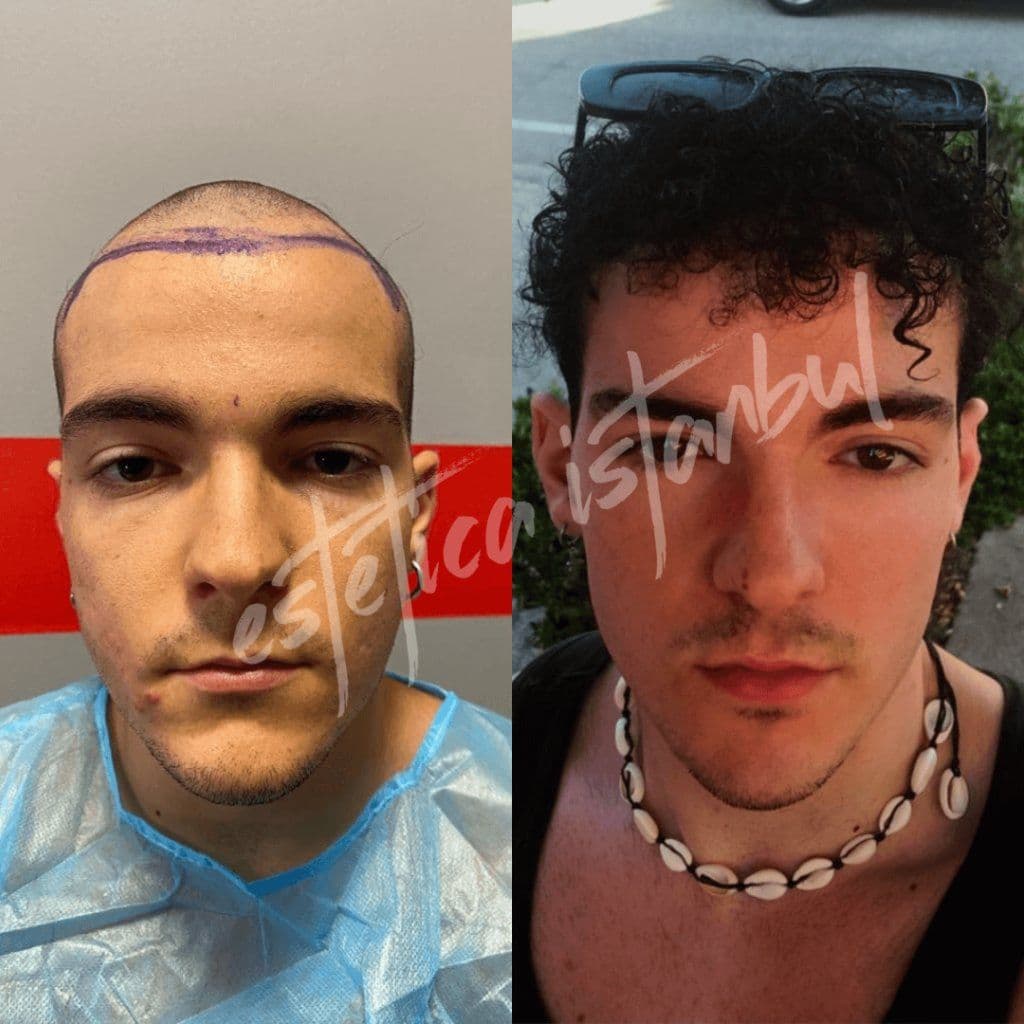 İstanbul'da Saç Ekimi Maliyeti Ne Kadar? 2026 Fiyat Rehberi